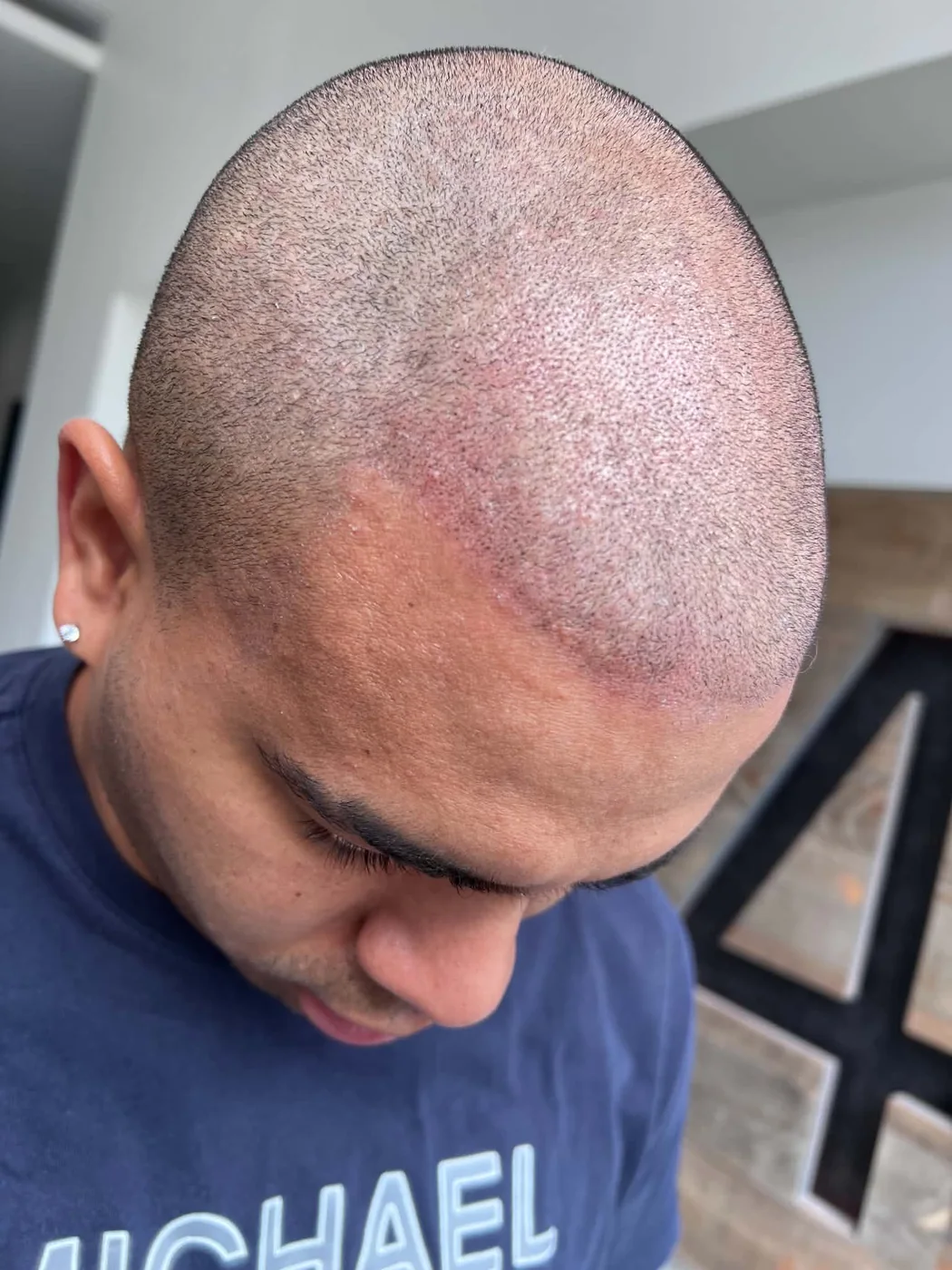 Scalp micropigmentation result