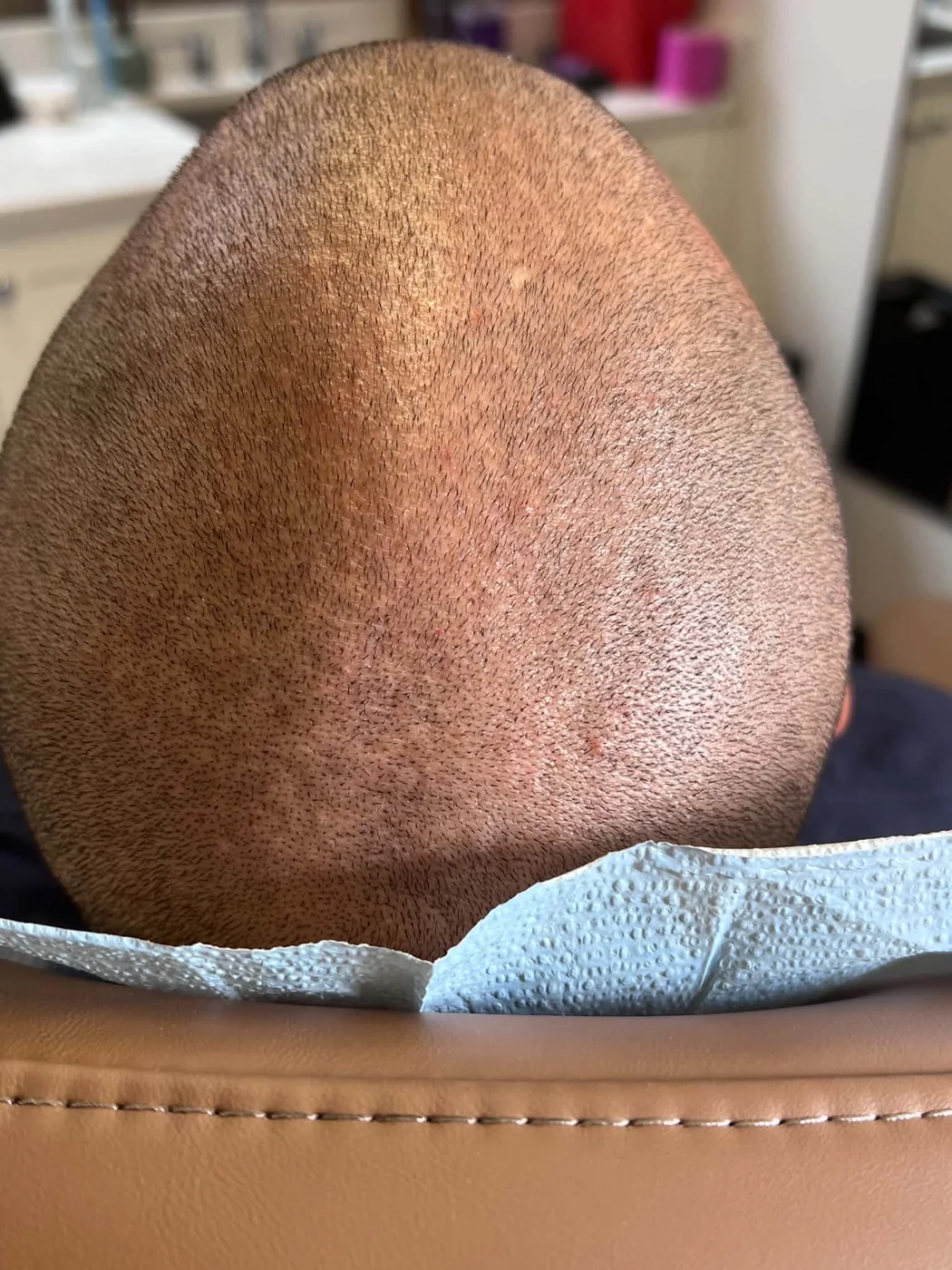 Scalp micropigmentation result