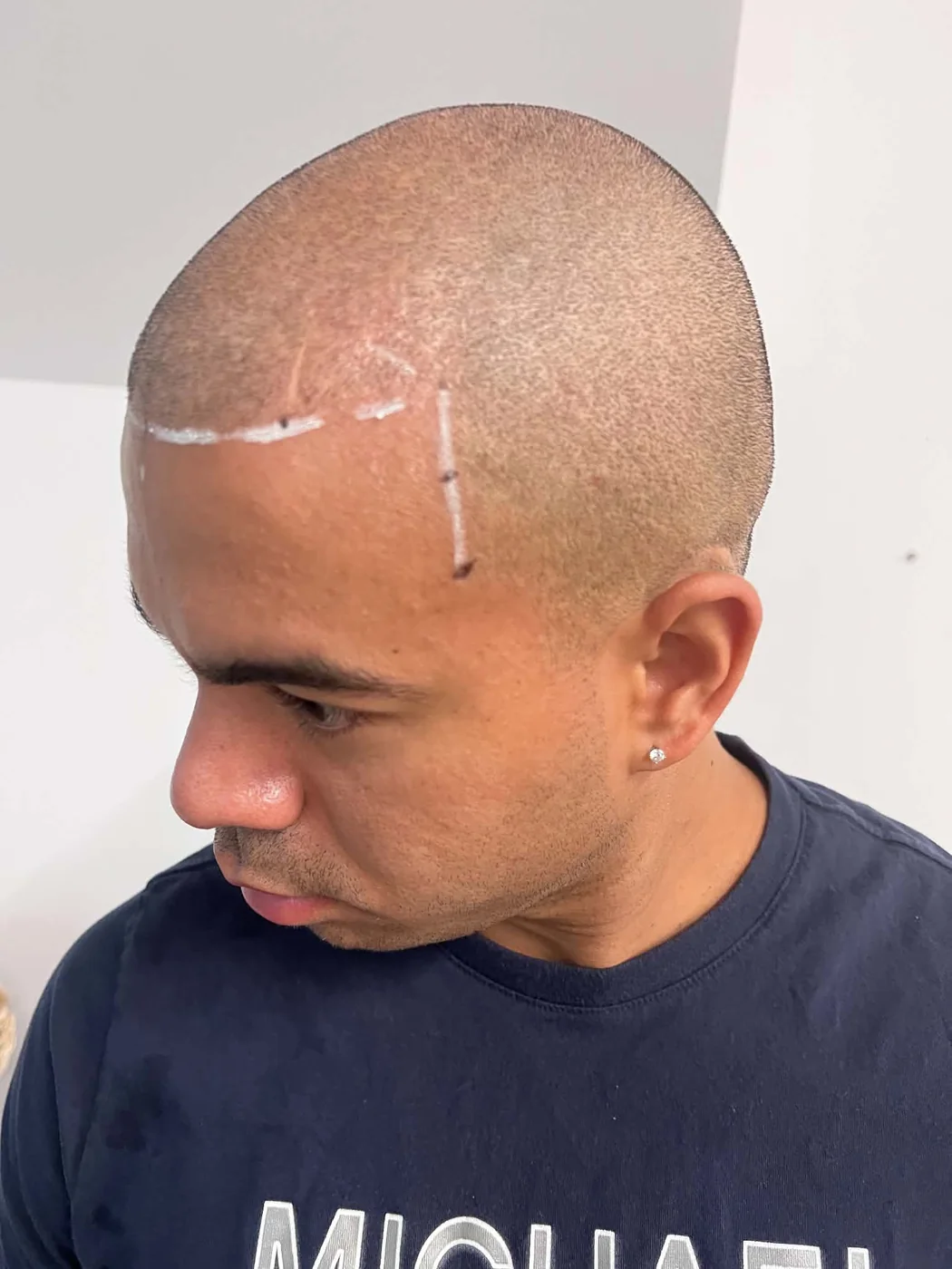 Scalp micropigmentation hairline result